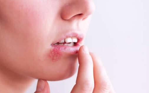 Herpes (Uçuk) Belirtileri, Tedavisi